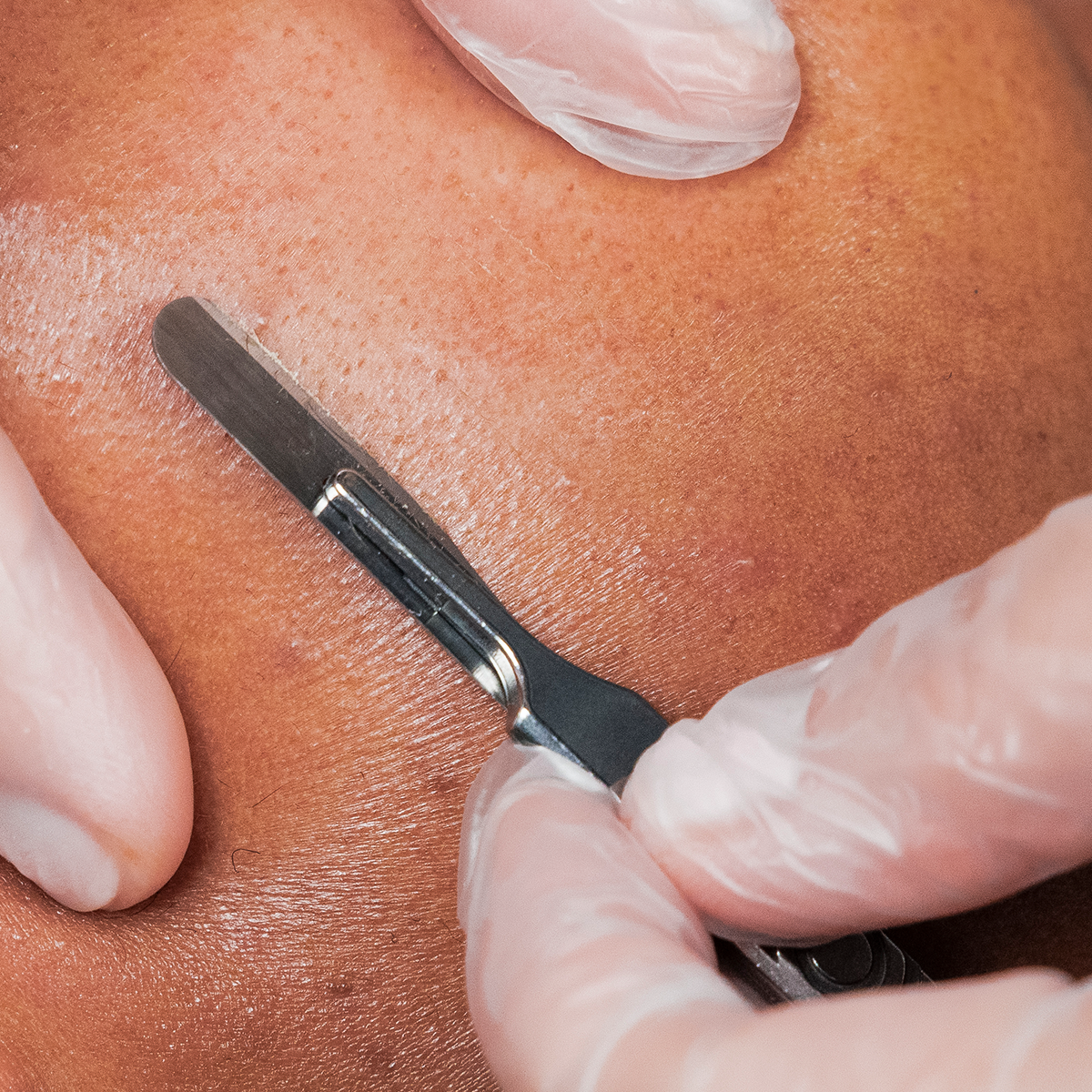 Dermaplaning treatment involves scraping away dead skin with a SCALPEL is  not for the faint-hearted