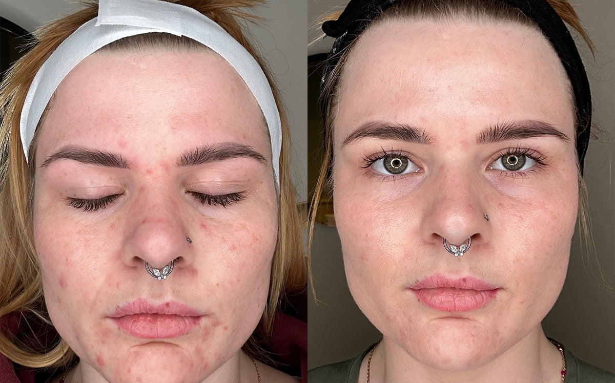 Rachel's Plasma Pen Journey: A Path to Radiance